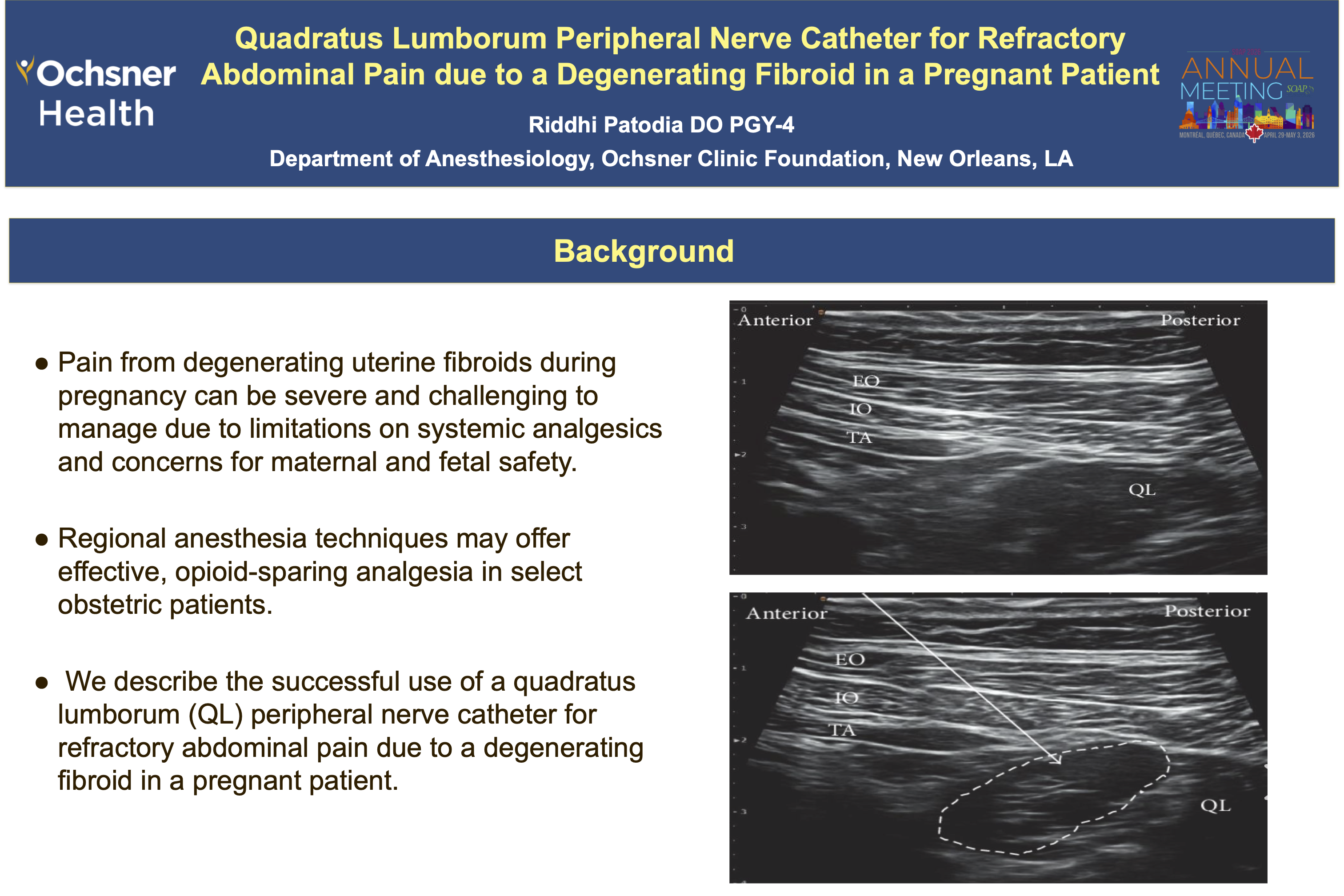 Thumbnail for Quadratus lumborum peripheral nerve catheter for refractory abdominal pain due to a degenerating fibroid in a pregnant patient.