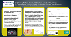 Thumbnail for Implantation of Fiducial Markers for Stereotactic Body Radiation Therapy for Prostate Cancer Treatment: A study conducted to minimize patient discomfort