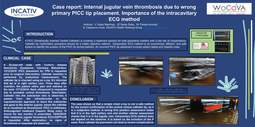 Preview of Case report: Internal jugular vein thrombosis due to wrong primary PICC tip placement. Importance of the intracavitary ECG method