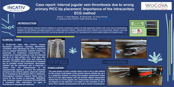Thumbnail for Case report: Internal jugular vein thrombosis due to wrong primary PICC tip placement. Importance of the intracavitary ECG method