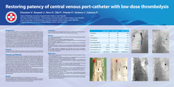 Thumbnail for Restoring patency of central venous port-catheter with low-dose thrombolysis