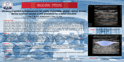 Thumbnail for Ultrasound-guided hydrodissection for totally implantable central venous access device reservoir pocket: a new procedure for a better outcome