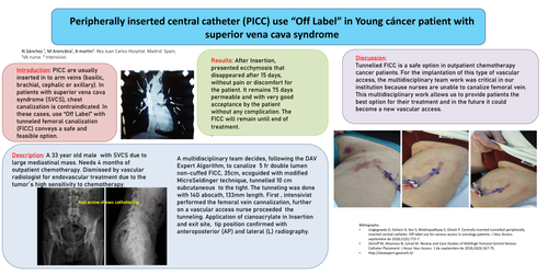 Preview of PICC “USE OF LABEL” IN YOUNG CANCER PATIENT WITH SUPERIOR VENA CAVA SYNDROME (SVCS)