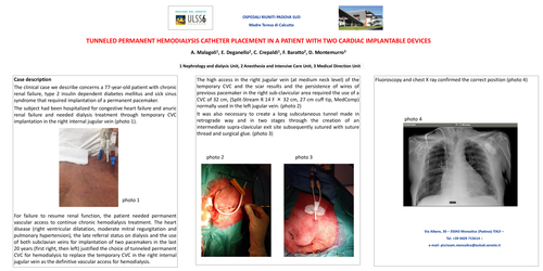Preview of Tunneled permanent hemodialysis catheter placement in a patient with two cardiac implantable devices