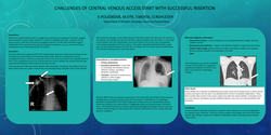 Thumbnail for Challenges of central venous access start with successful insertion 