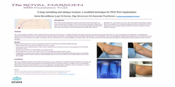 Thumbnail for C-loop tunnelling and oblique incision: a modified technique for PICC-Port implantation