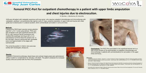 Preview of FEMORAL PICC-Port for outpatient chemotherapy in a patient with upper limbs amputation and chest injuries due to electrocution.