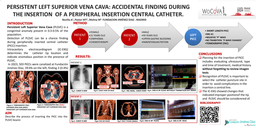 Preview of Persistent left superior vena cava: accidental finding during the insertion of a peripherally inserted central catheter