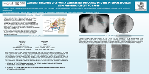 Preview of CATHETER FRACTURE OF A PORT-A-CATH SYSTEM IMPLANTED INTO THE INTERNAL JUGULAR VEIN: PRESENTATION OF TWO CASES