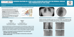 Thumbnail for CATHETER FRACTURE OF A PORT-A-CATH SYSTEM IMPLANTED INTO THE INTERNAL JUGULAR VEIN: PRESENTATION OF TWO CASES