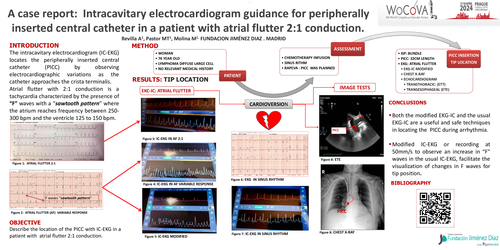 Preview of A case report: intracavitary electrocardiogram guidance for peripherally inserted central catheter in a patient with atrial flutter 2:1 conduction